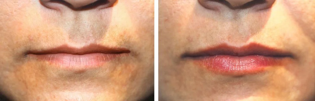 restylane-before-after-14-1024x329