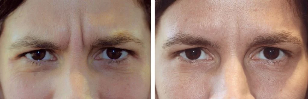 restylane-before-after-15-1024x329