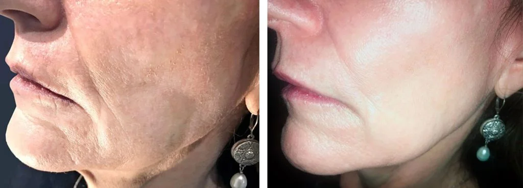 restylane-before-after-2-1024x369