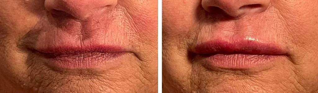 restylane-before-after-3-1024x301
