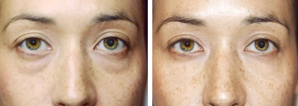 restylane-before-after-4-1024x364