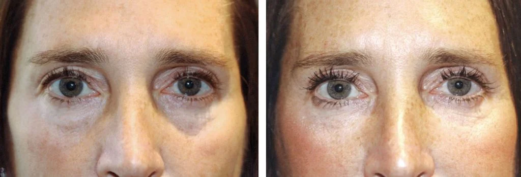 restylane-before-after-5-1024x349