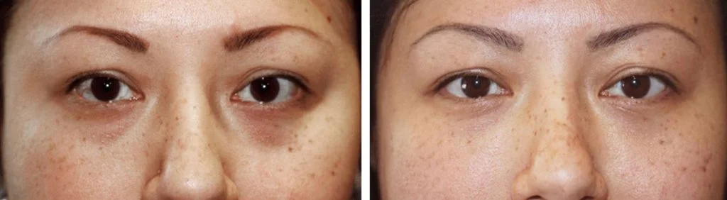 restylane-before-after-6-1024x282