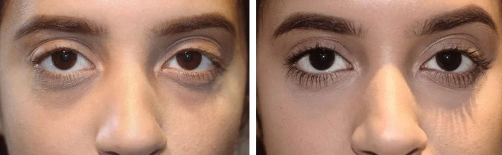 restylane-before-after-7-1024x316