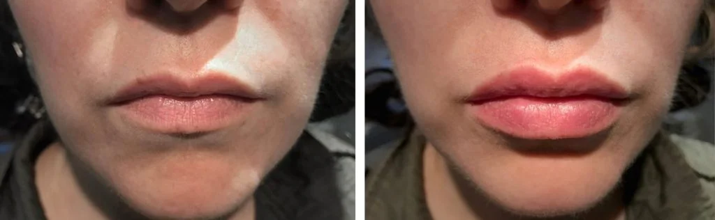restylane-before-after-8-1024x316