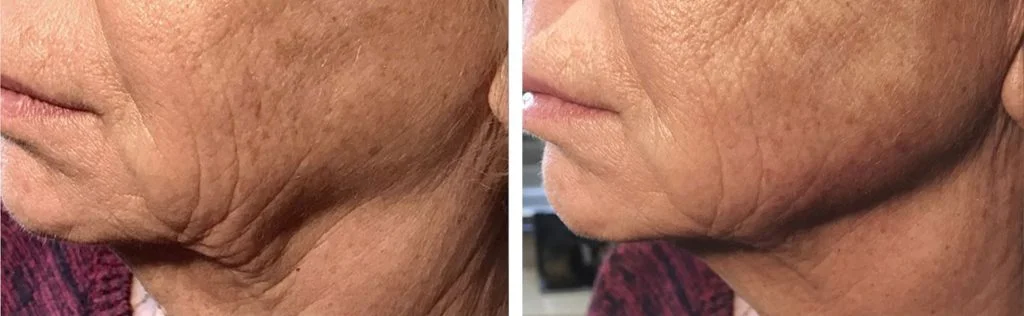 restylane-before-after-9-1024x316