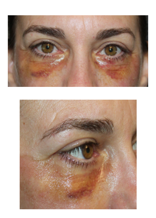 1 Week and 2 Months Following a Lower Eyelid Blepharoplasty With Skin Pinch, Canthopexy, and TCA Peel. 1 Week After