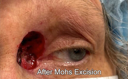 Eyelid Reconstruction After Skin Cancer After Surgery