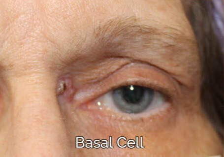 Eyelid Reconstruction After Skin Cancer Basal Cell