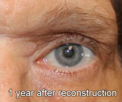 Eyelid Reconstruction After Skin Cancer 1 Year After Reconstruction