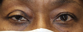Ptosis repair on Right Eyelid. Before