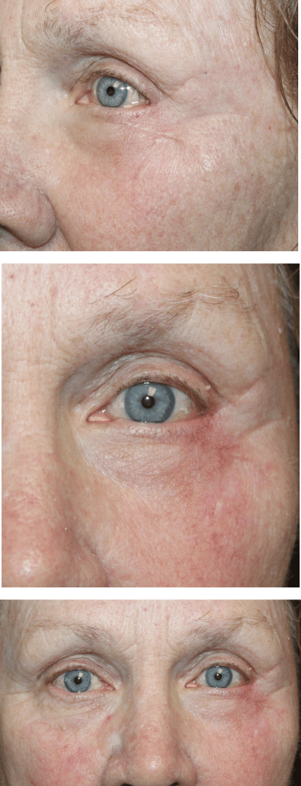 3 Directional Flap for a Large Defect 2 Months After