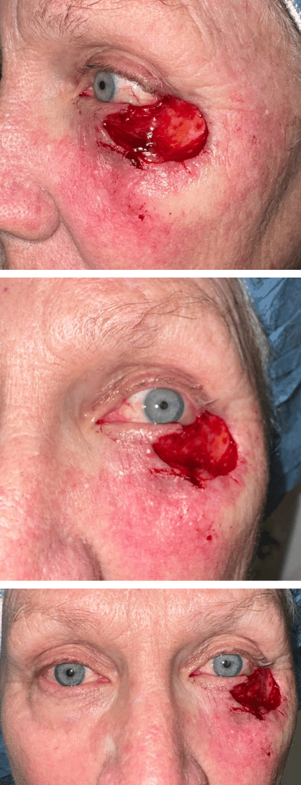 3 Directional Flap for a Large Defect Post Op