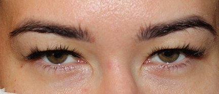 Upper Blepharoplasty Before