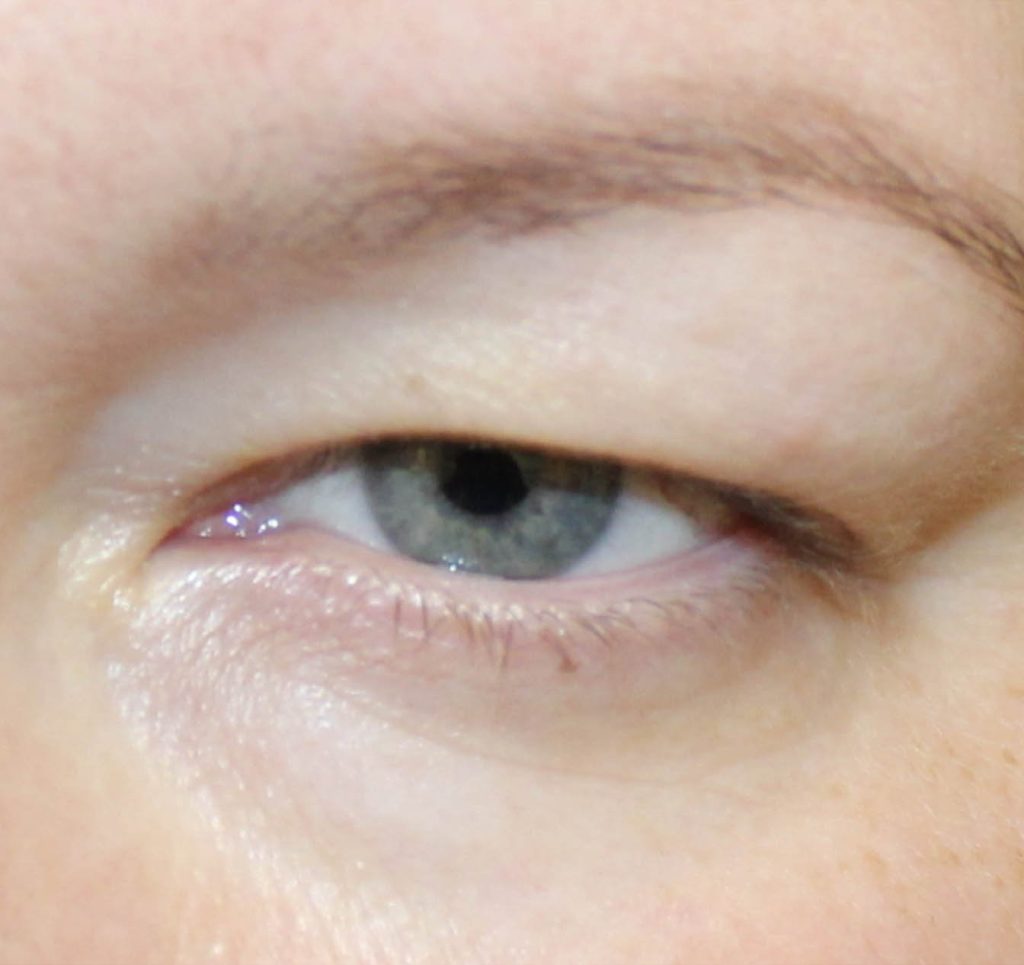 Upper Blepharoplasty Before