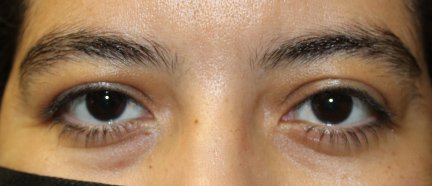 Internal Ptosis repair on Left Side. After