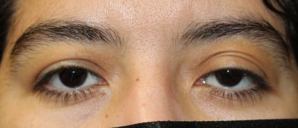 Internal Ptosis repair on Left Side. Before
