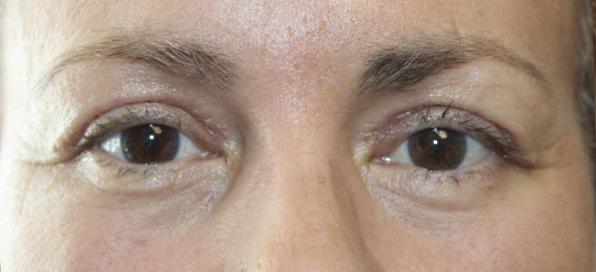 Upper and Lower Blepharoplasty After