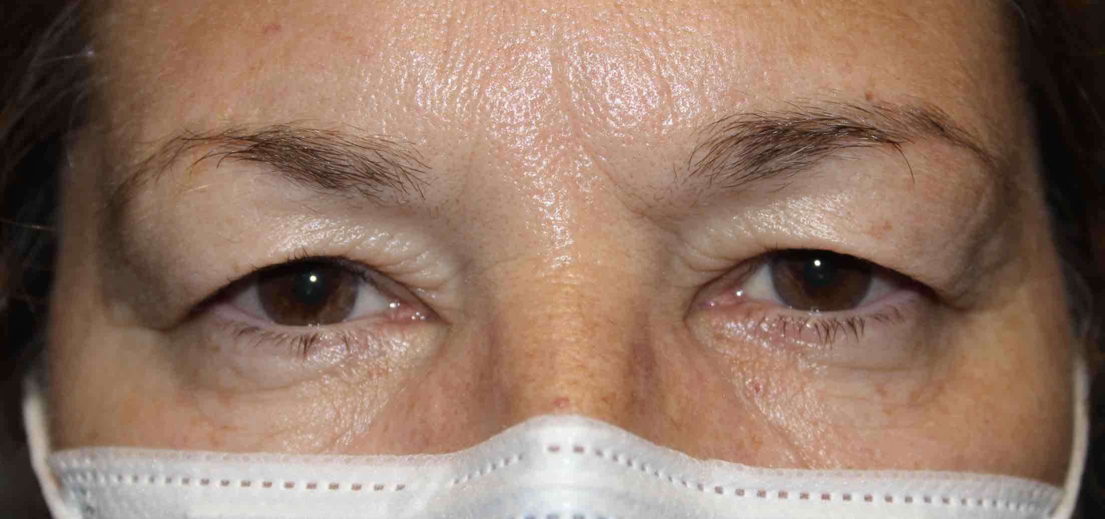 Upper Blepharoplasty after 1 week Before