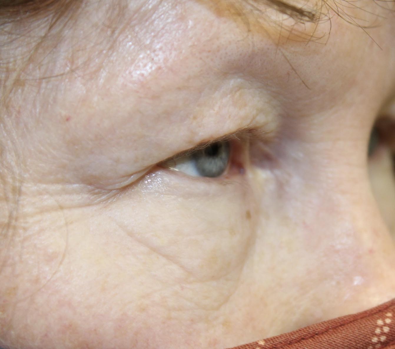 Upper & Lower Blepharoplasty with Lower Eyelid TCA Peel - After 1 Week Before