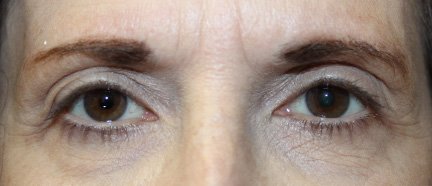 Internal Ptosis repair on Right Eye. After