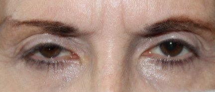 Internal Ptosis repair on Right Eye. Before