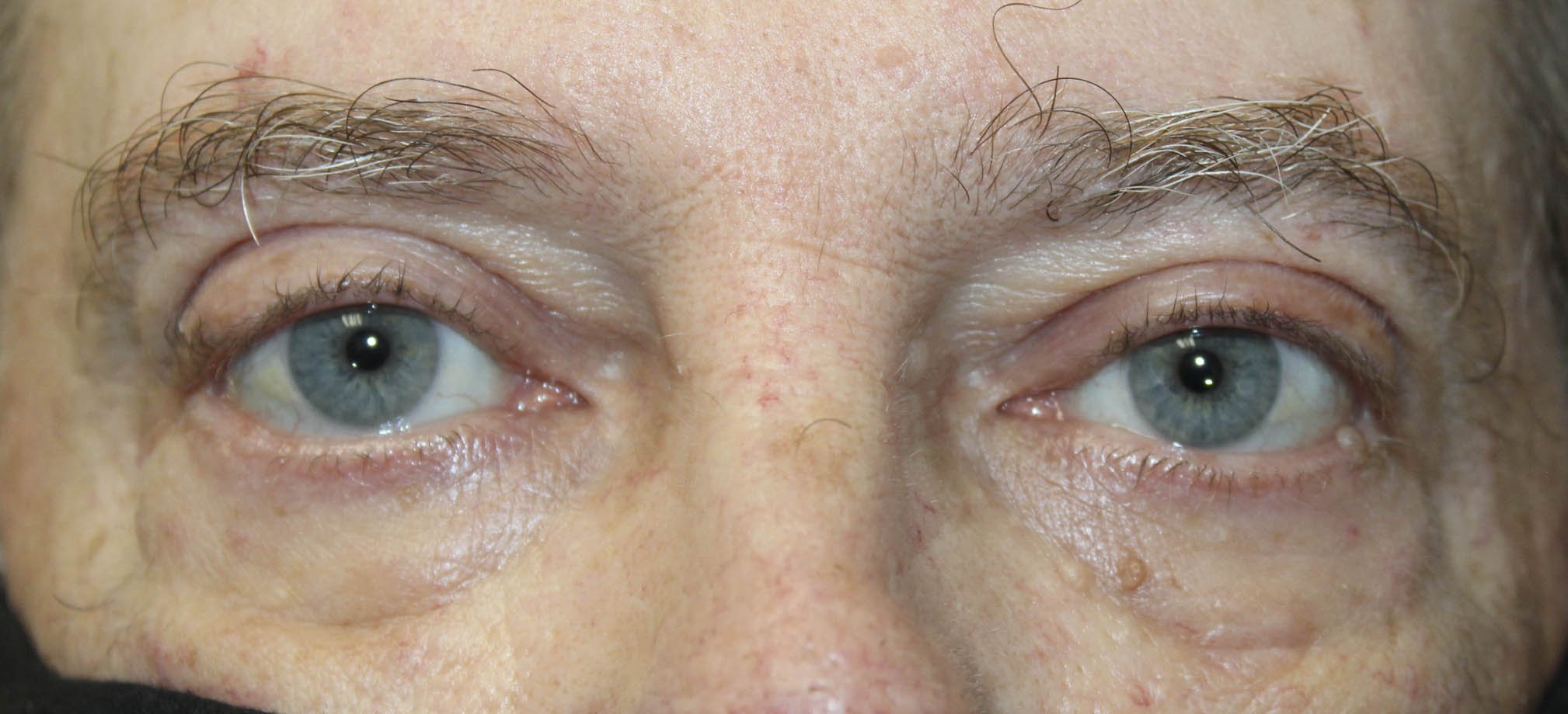 External Ptosis Repair After