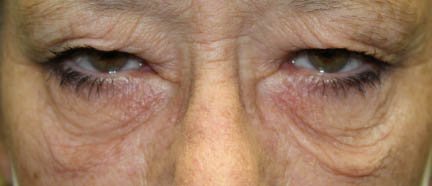 Upper & Lower Blepharoplasty & Direct Brow Ptosis Repair. Before