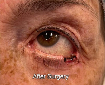 Eyelid Reconstruction After Surgery