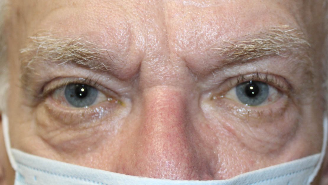 Lower Blepharoplasty, Canthopexy and TCA Peel Before