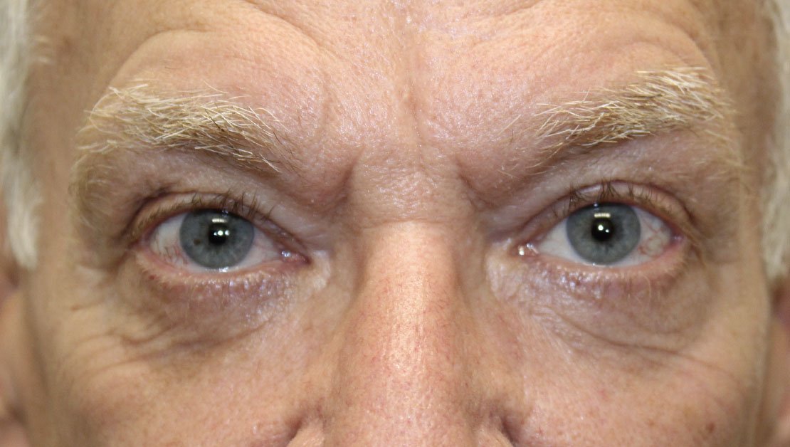 Lower Blepharoplasty, Canthopexy and TCA Peel After
