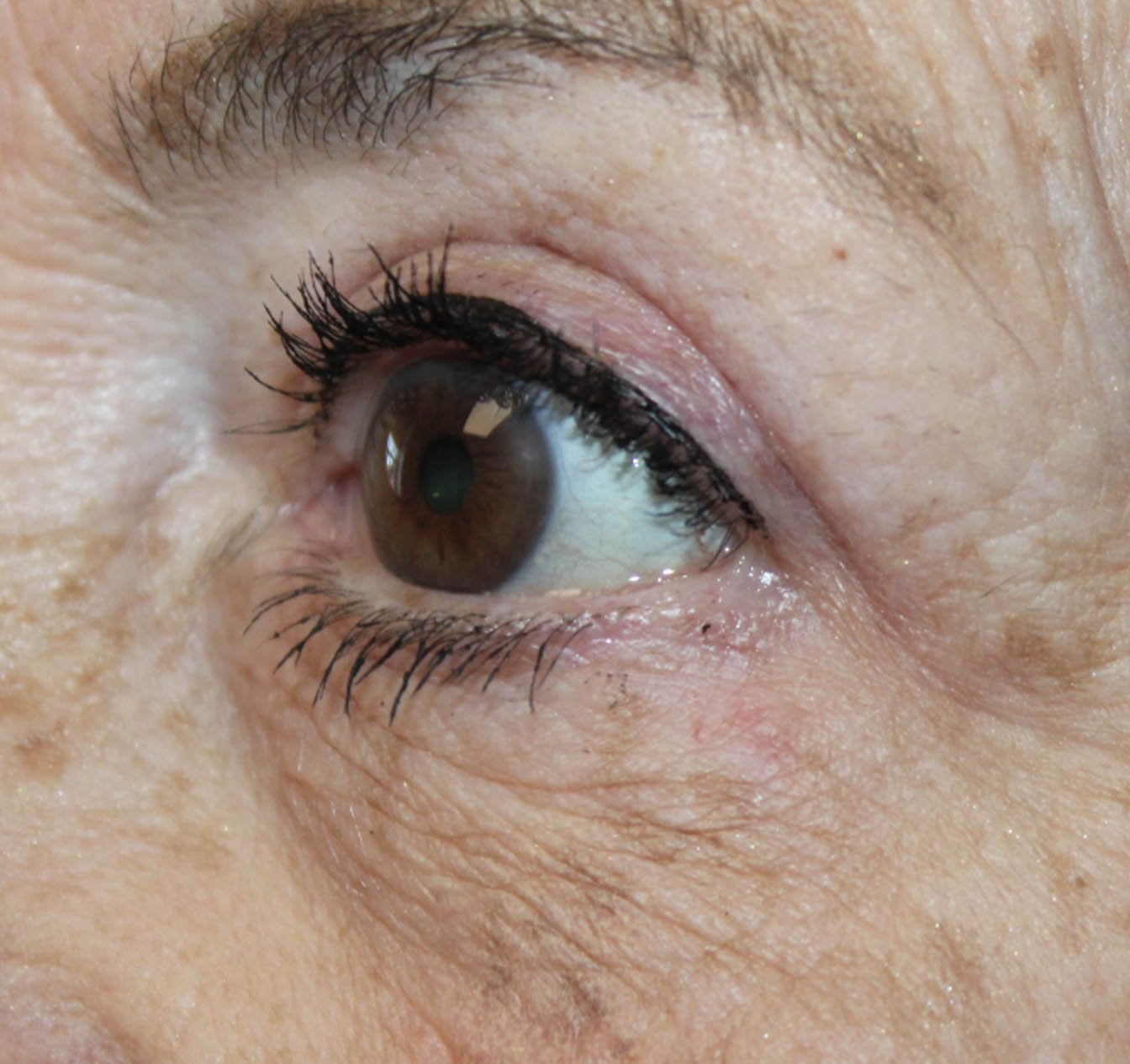 Basal Cell with Wedge Excision after 6 months After