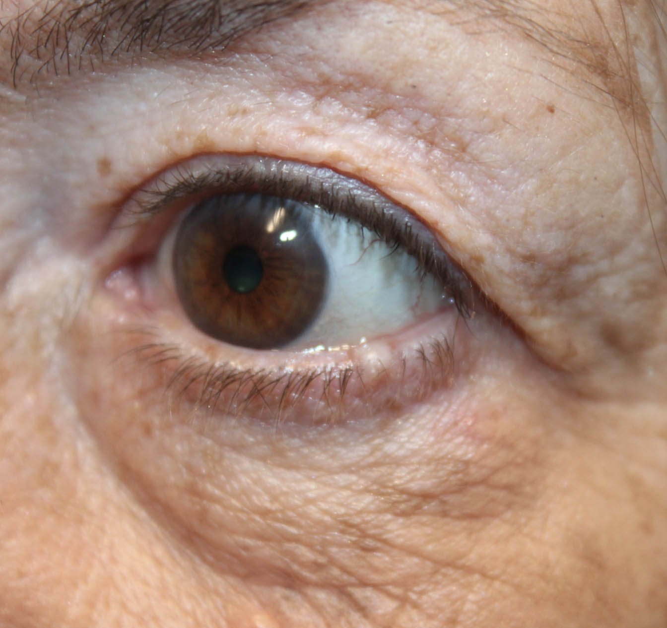 Basal Cell with Wedge Excision after 6 months Before