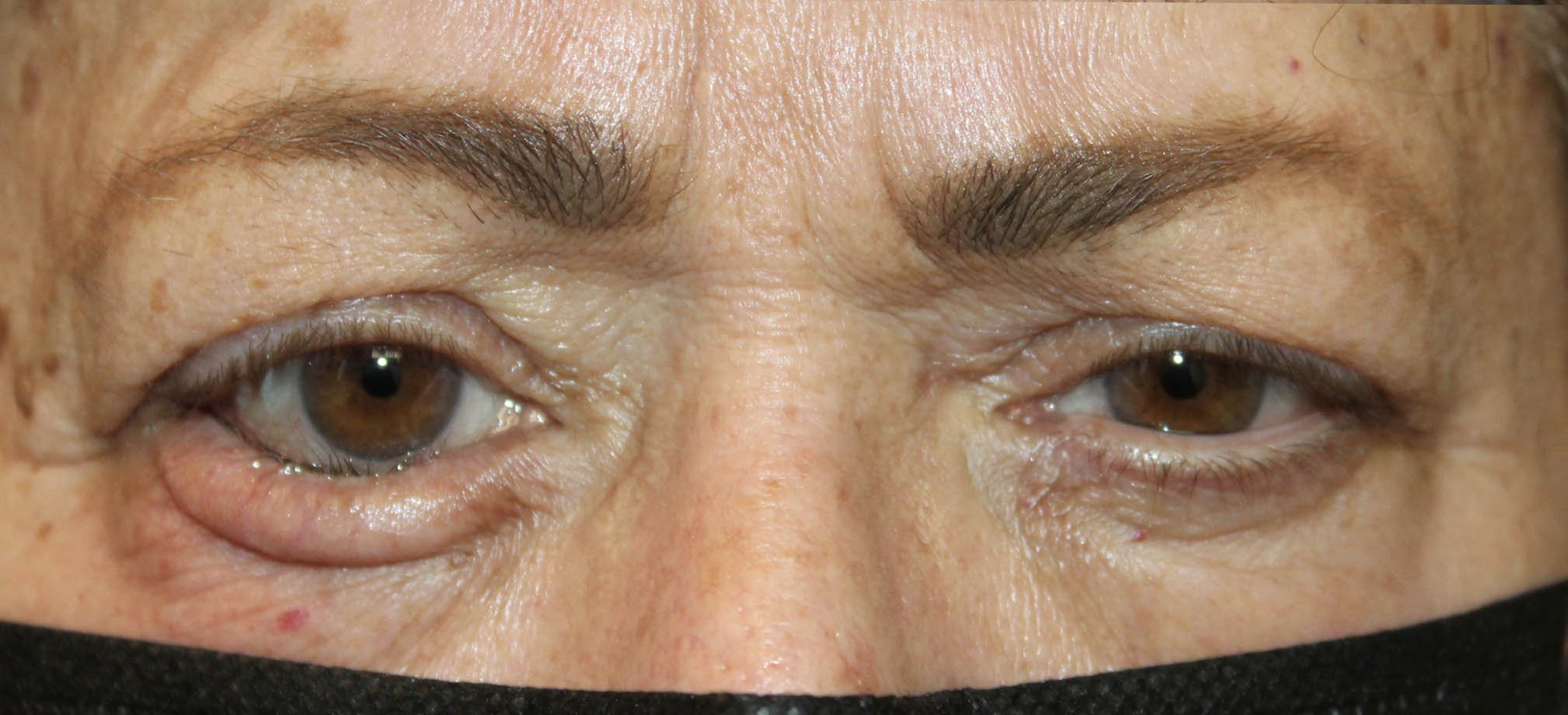 Right Lower Eyelid Entropion Repair Before
