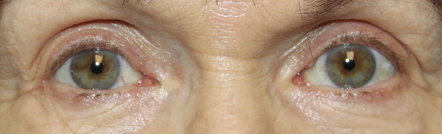 Bilateral Internal Ptosis Repair After