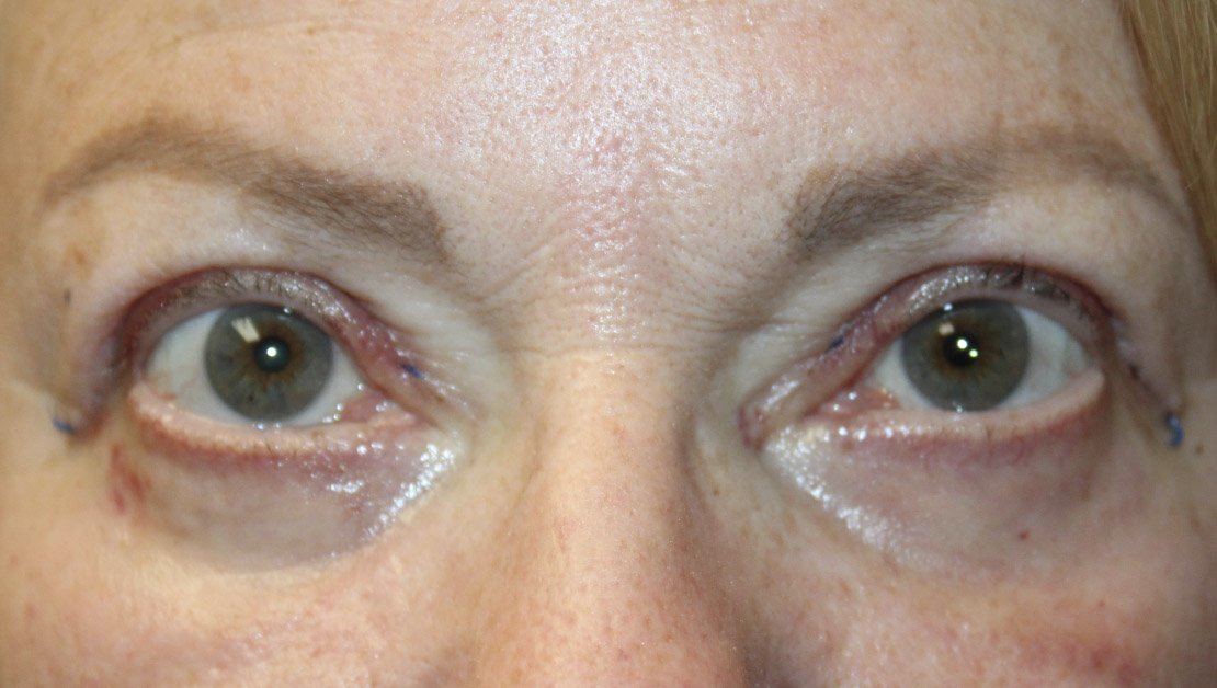Upper and Lower Blepharoplasty with TCA peel After