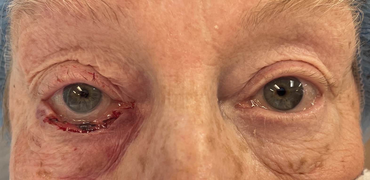 Eyelid Reconstruction Before