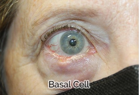 Eyelid Reconstruction After Skin Cancer Removal