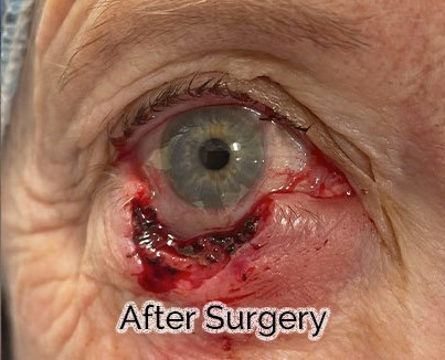 Eyelid Reconstruction After Skin Cancer Removal After Surgery
