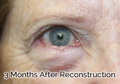 Eyelid Reconstruction After Skin Cancer Removal