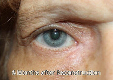 Eyelid & Tear Duct Reconstruction 6 Months Post Reconstruction