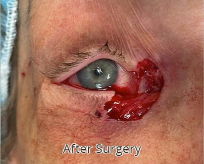 Eyelid & Tear Duct Reconstruction After Surgery