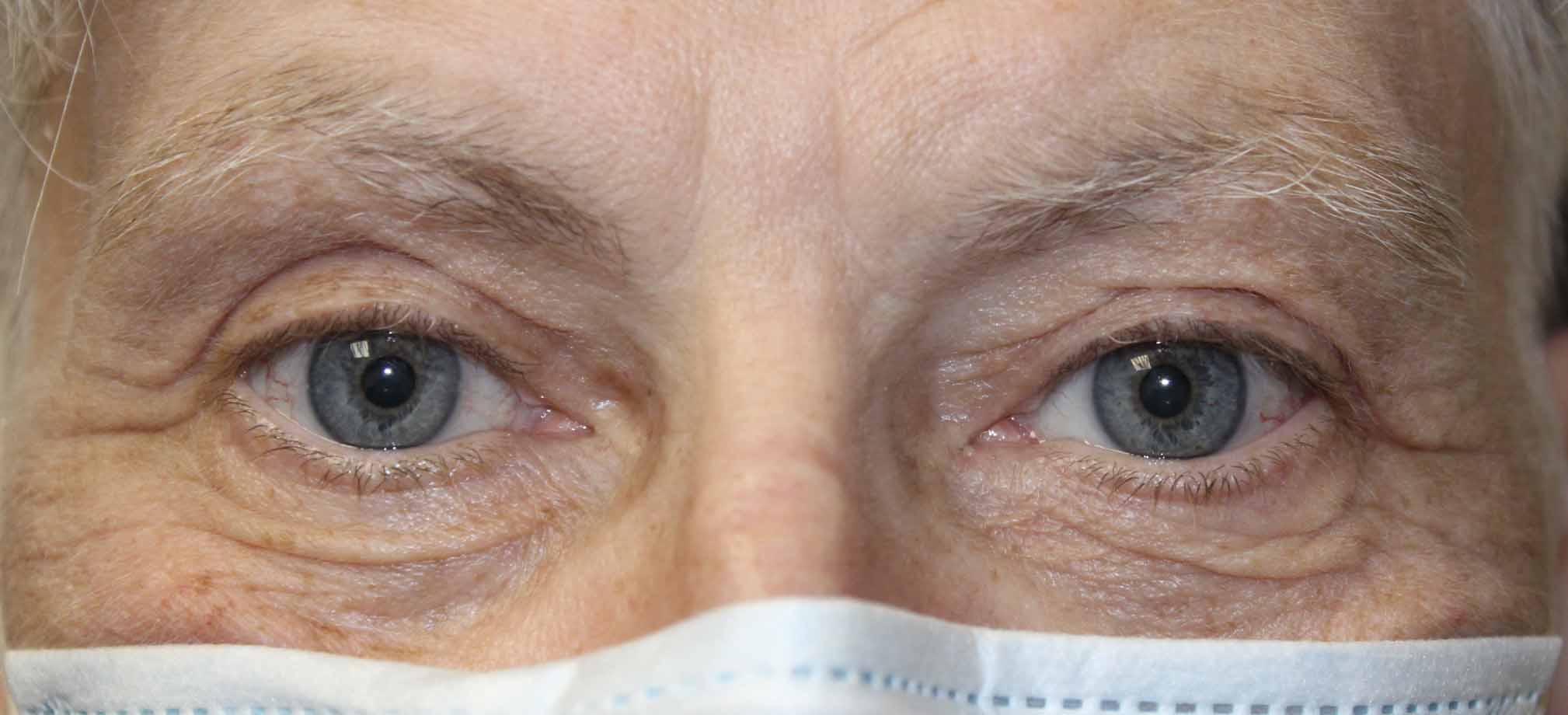 Upper Eyelid External Ptosis Repair After
