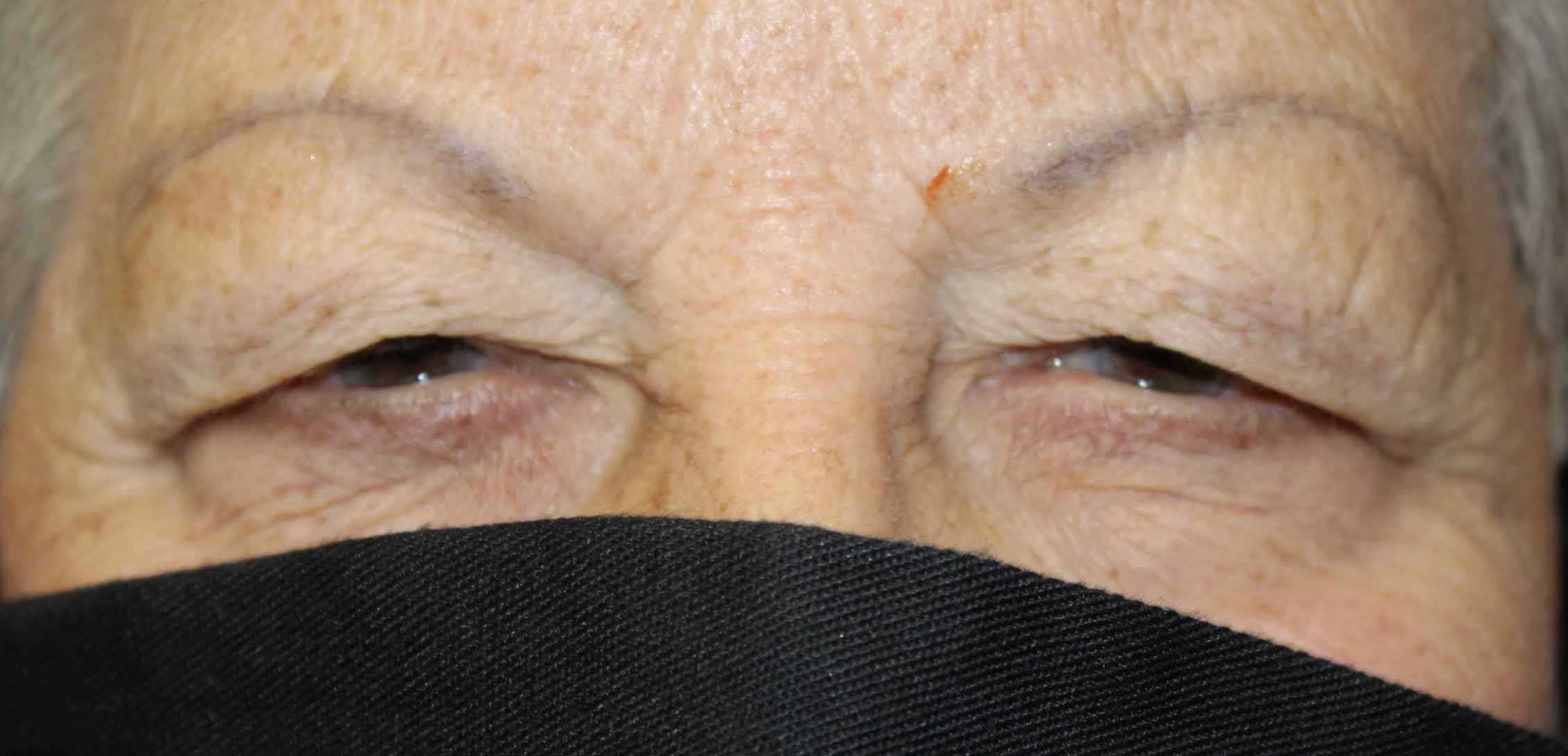 Upper Blepharoplasty Before