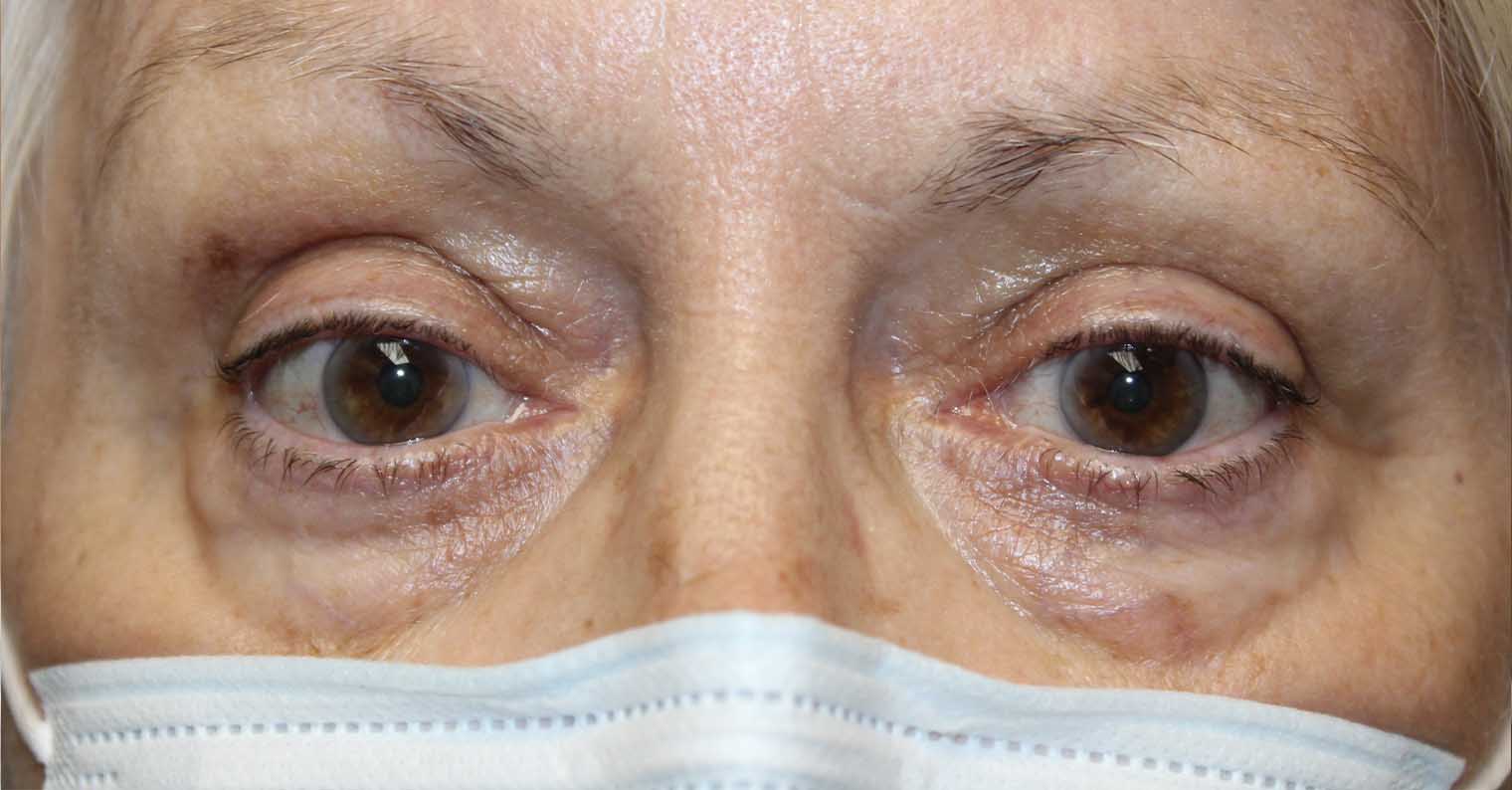Upper Eyelid Retraction Repair for Thyroid Eye Disease After