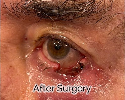 Eyelid Reconstruction After Skin Cancer Removal After Surgery