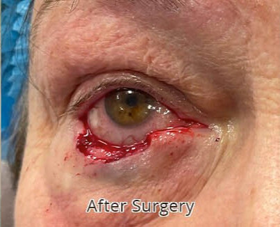 Repair of 60% Defect of Eyelid from Basal Cell Carcinoma with a Hughes flap: After Surgery