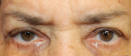 Upper Blepharoplasty & Brow Lift After