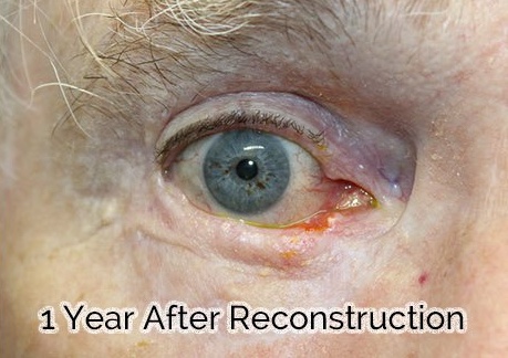 Total Lower Eyelid Reconstruction After Skin Cancer Removal