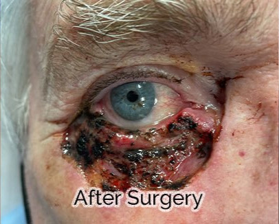 Total Lower Eyelid Reconstruction After Skin Cancer Removal After Surgery Image